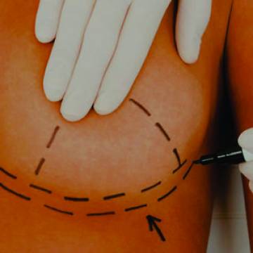 Mamoplastia redutora